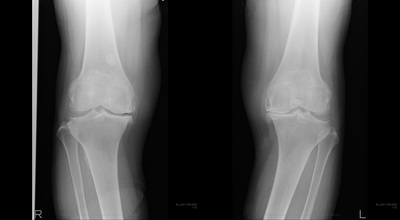 kneeoa01_01.jpg