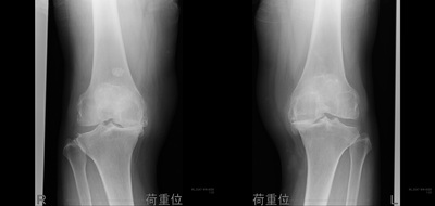 kneeoa01_02.jpg