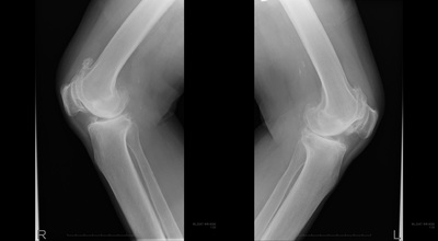 kneeoa01_03.jpg